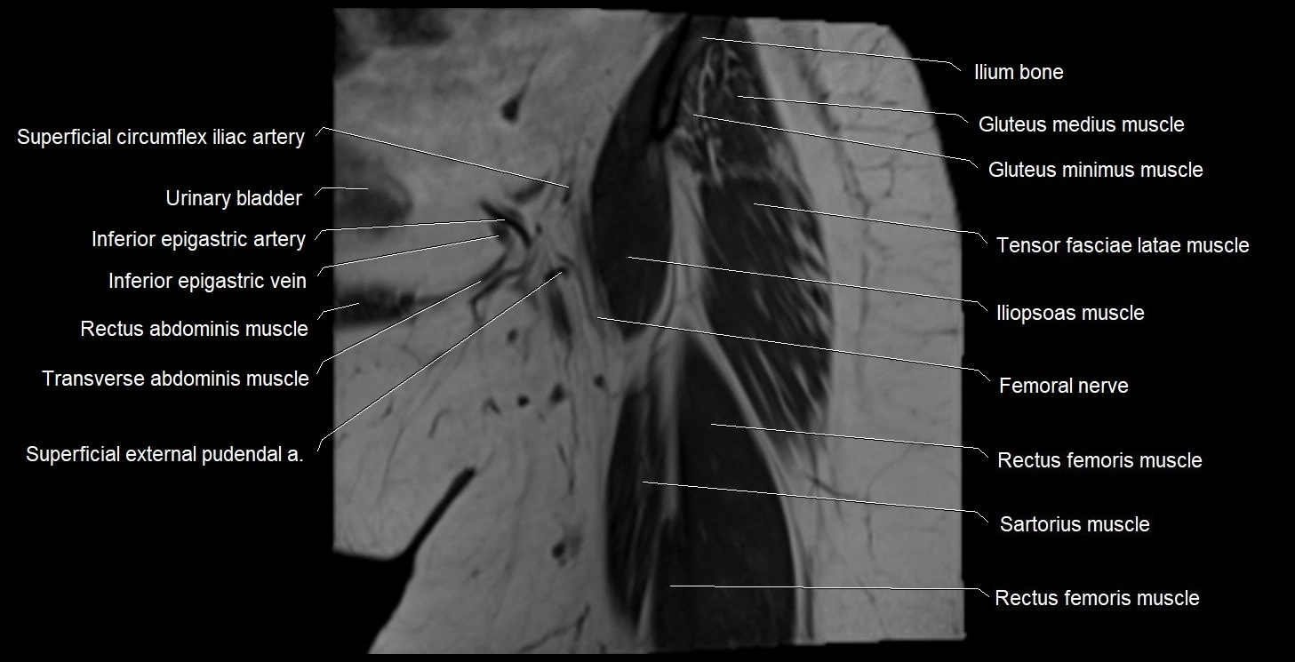 MRI Hip 3T coronal cross sectional anatomy image 6.webp